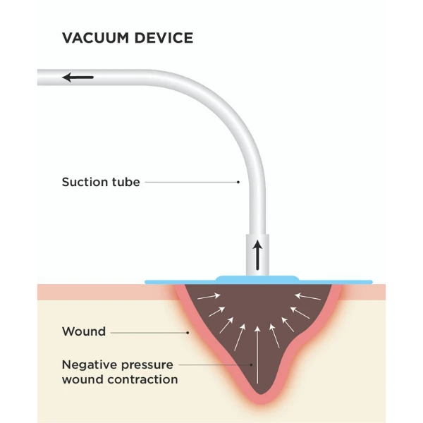 TH-En-Application-Chart-oem-pumps-for-negative-pressure-wound-therapy